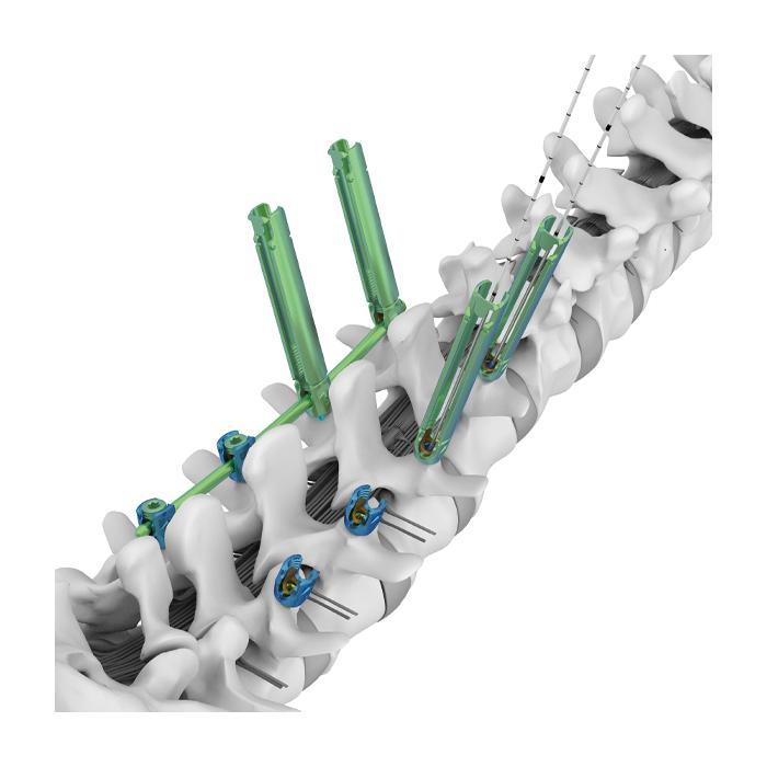 TINA MIS - малоінвазивна транспедикулярна система фіксації хребта